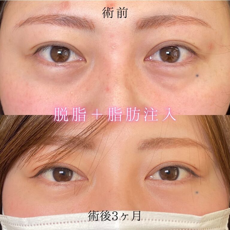 eクリニック新宿院の経血膜脱脂の症例写真(5)