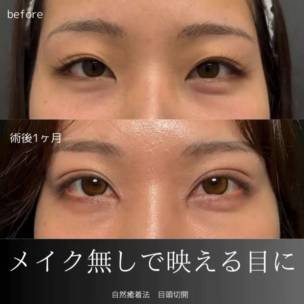自然癒着法
