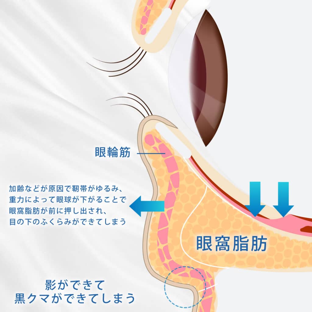 目の下のふくらみができる図解