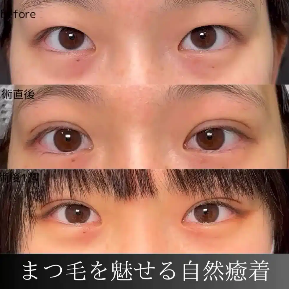 自然癒着法