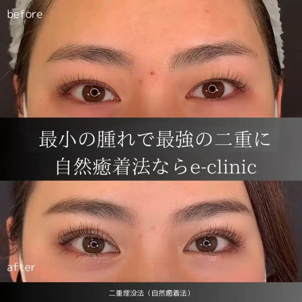 自然癒着法