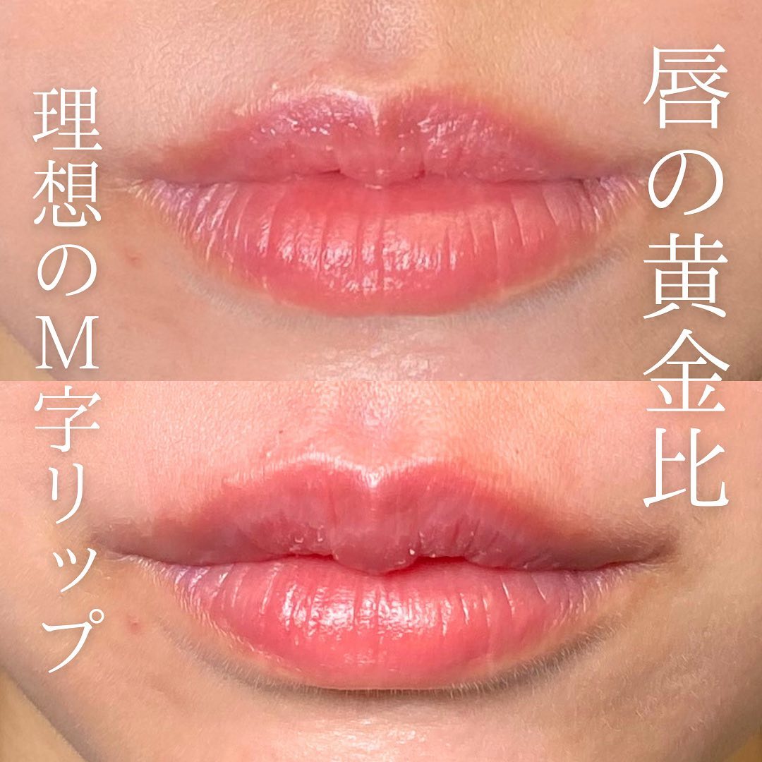 唇のヒアルロン酸の症例写真