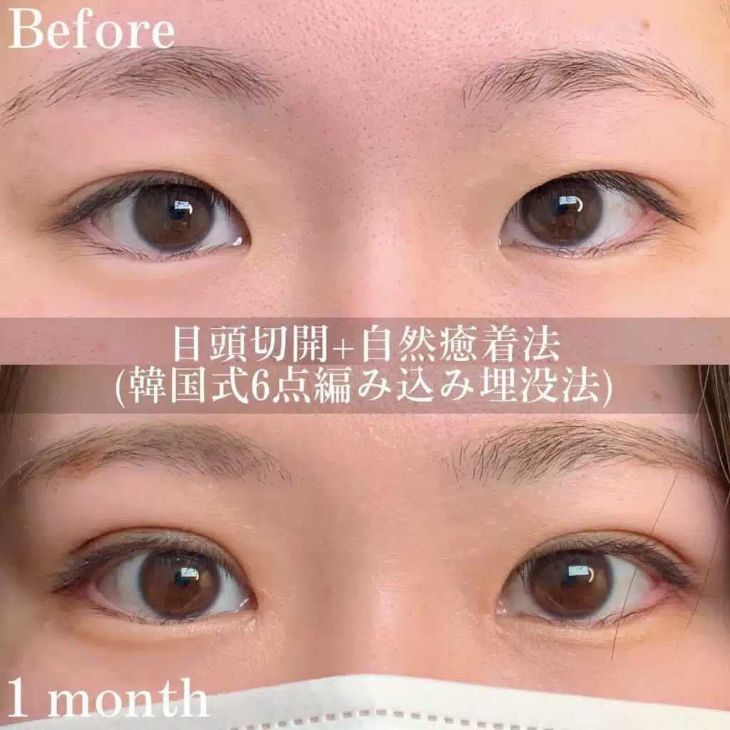 自然癒着法