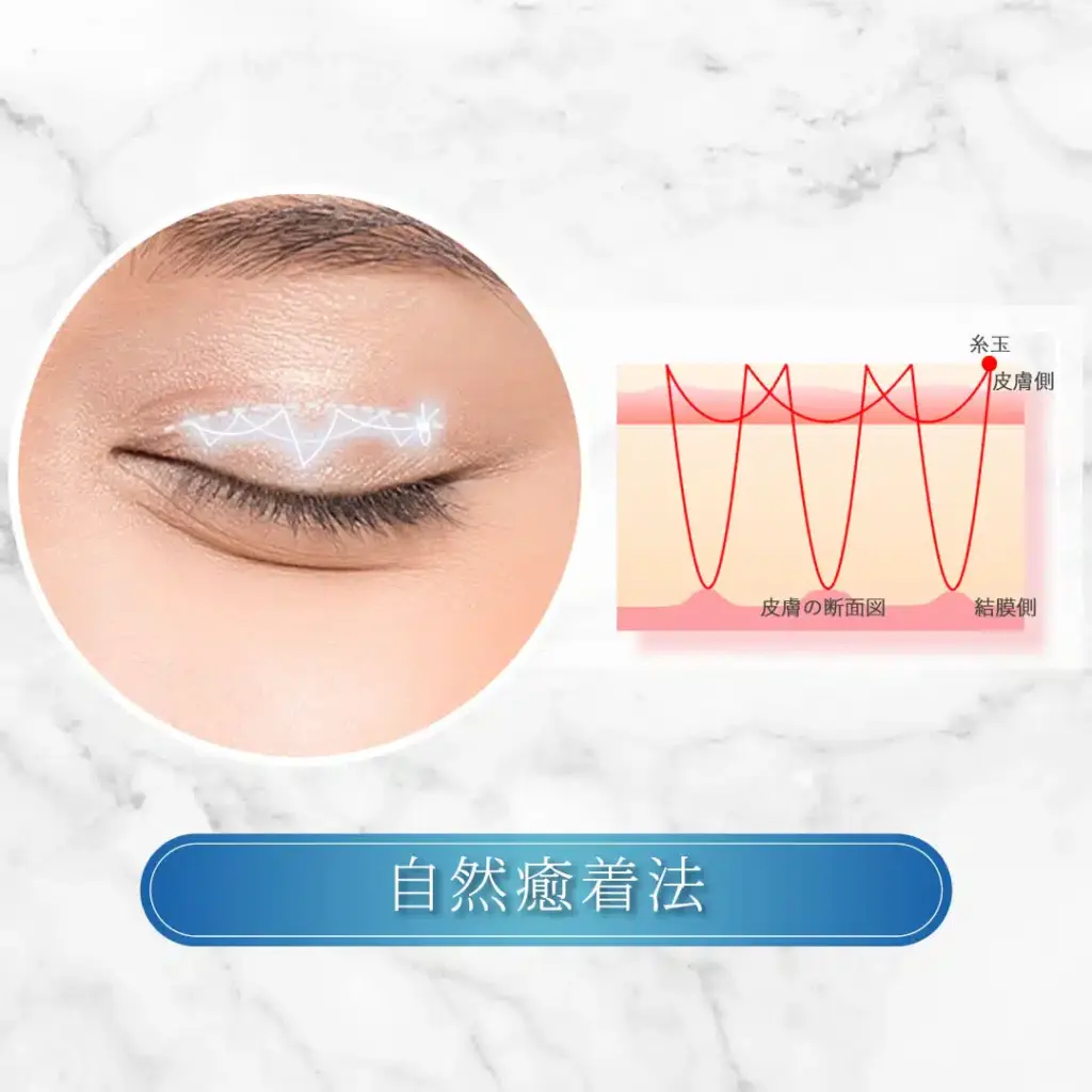 自然癒着法