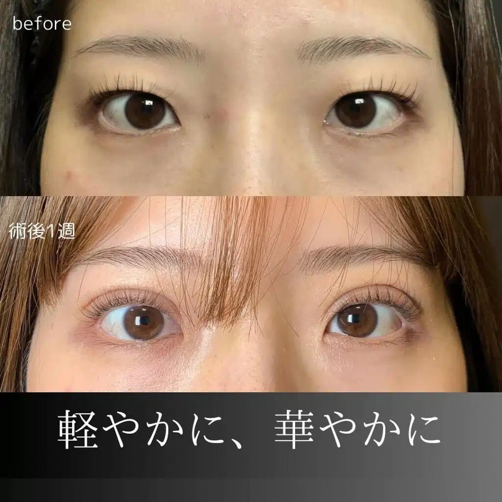 自然癒着法