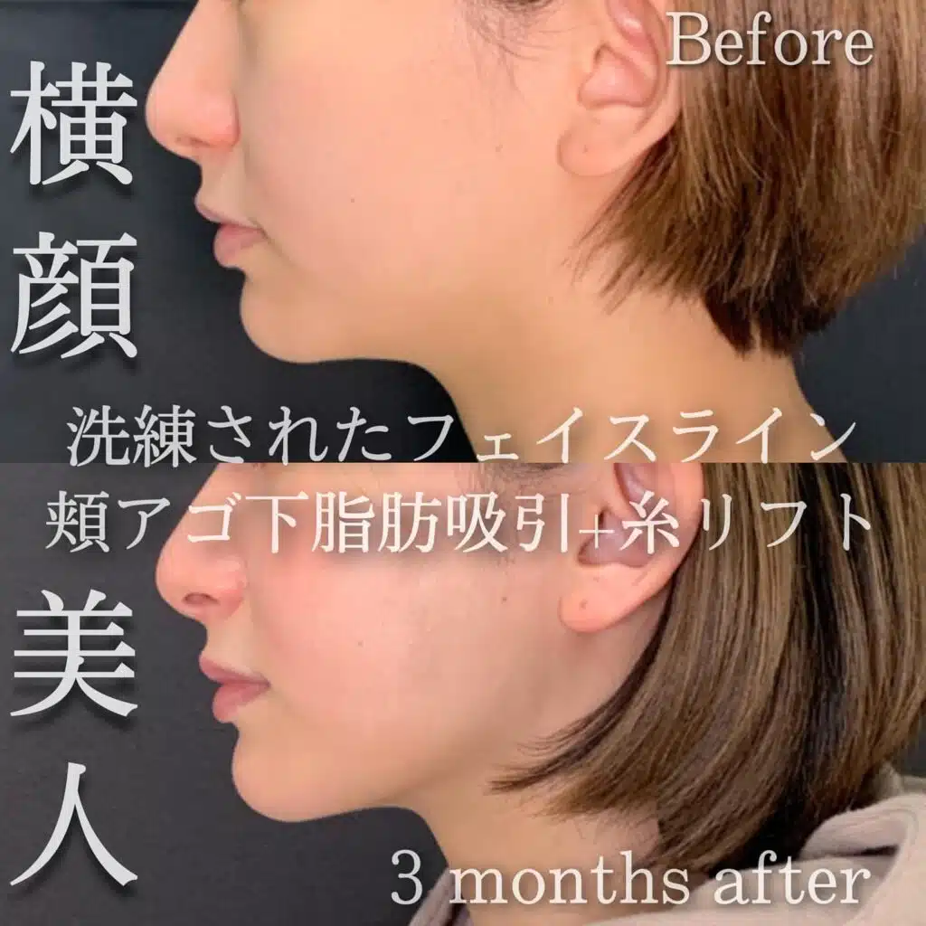 顔の脂肪吸引