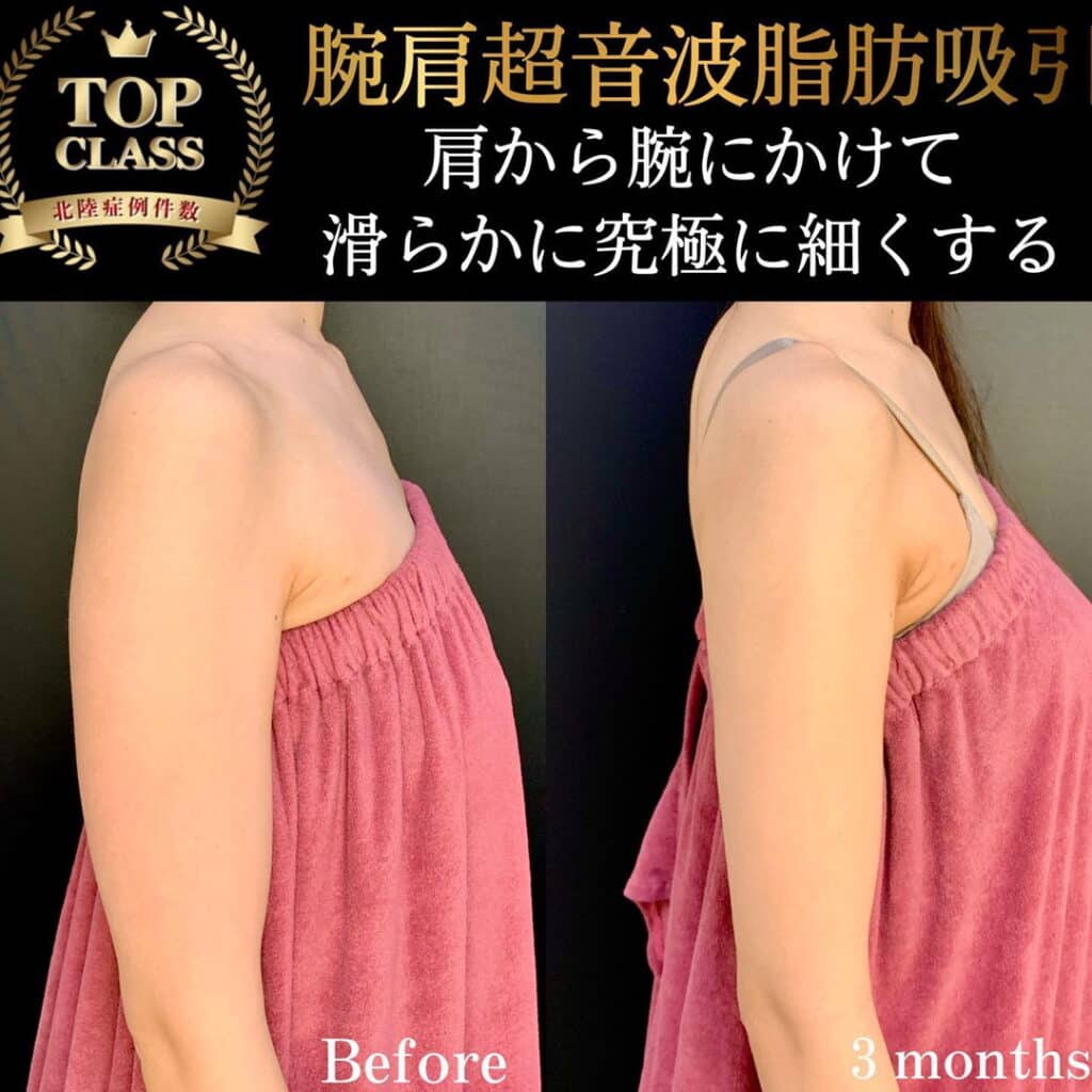 eclinic新宿院の腕脂肪吸引の症例写真