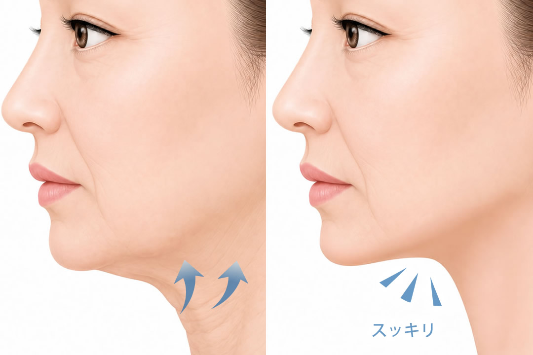 ネックリフト手術のイメージ