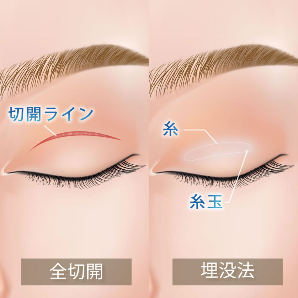 埋没法と全切開の図解