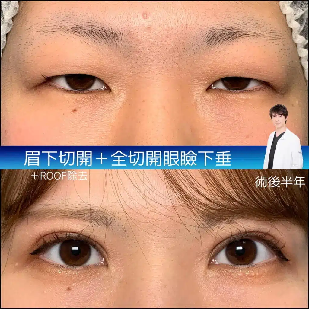眼瞼下垂手術（目つき矯正）
