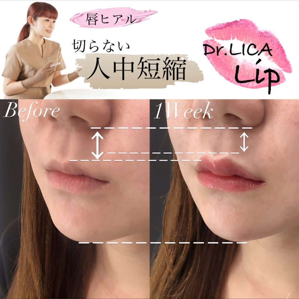 唇のヒアルロン酸で人中を短縮した症例写真