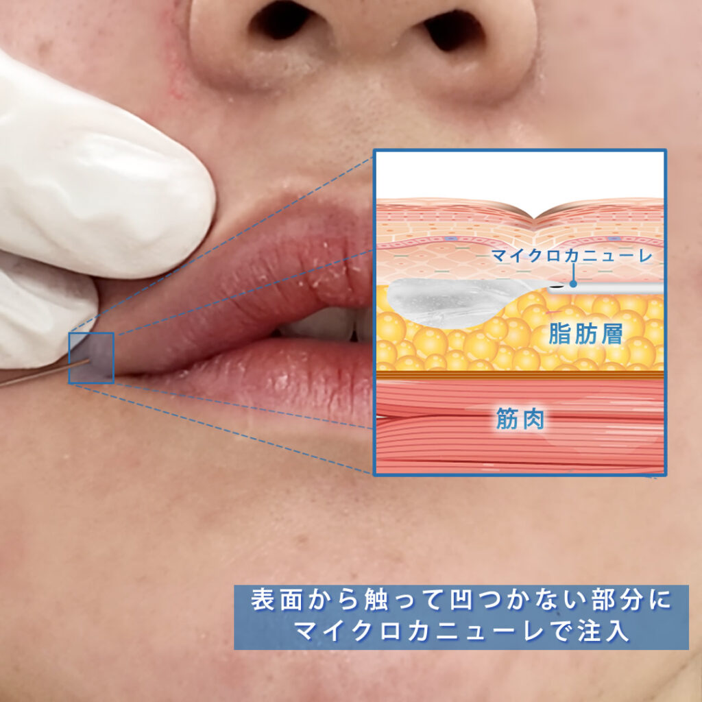 唇にヒアルロン酸を注入している所