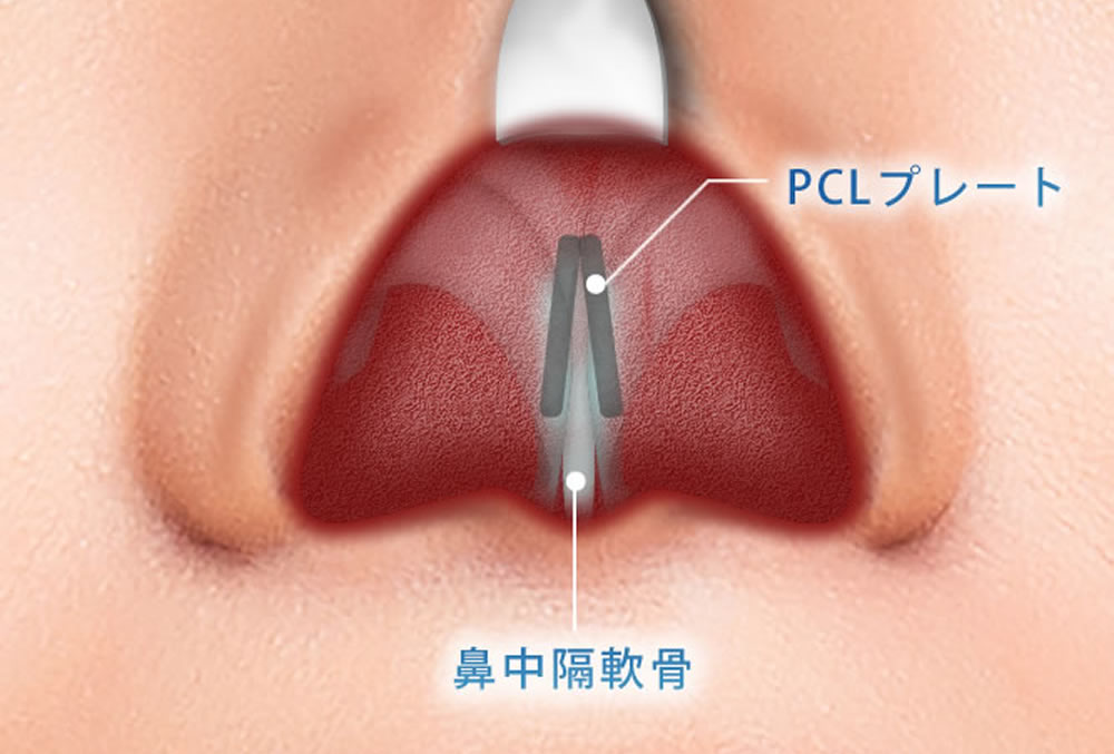 PCLプレートを説明している図解