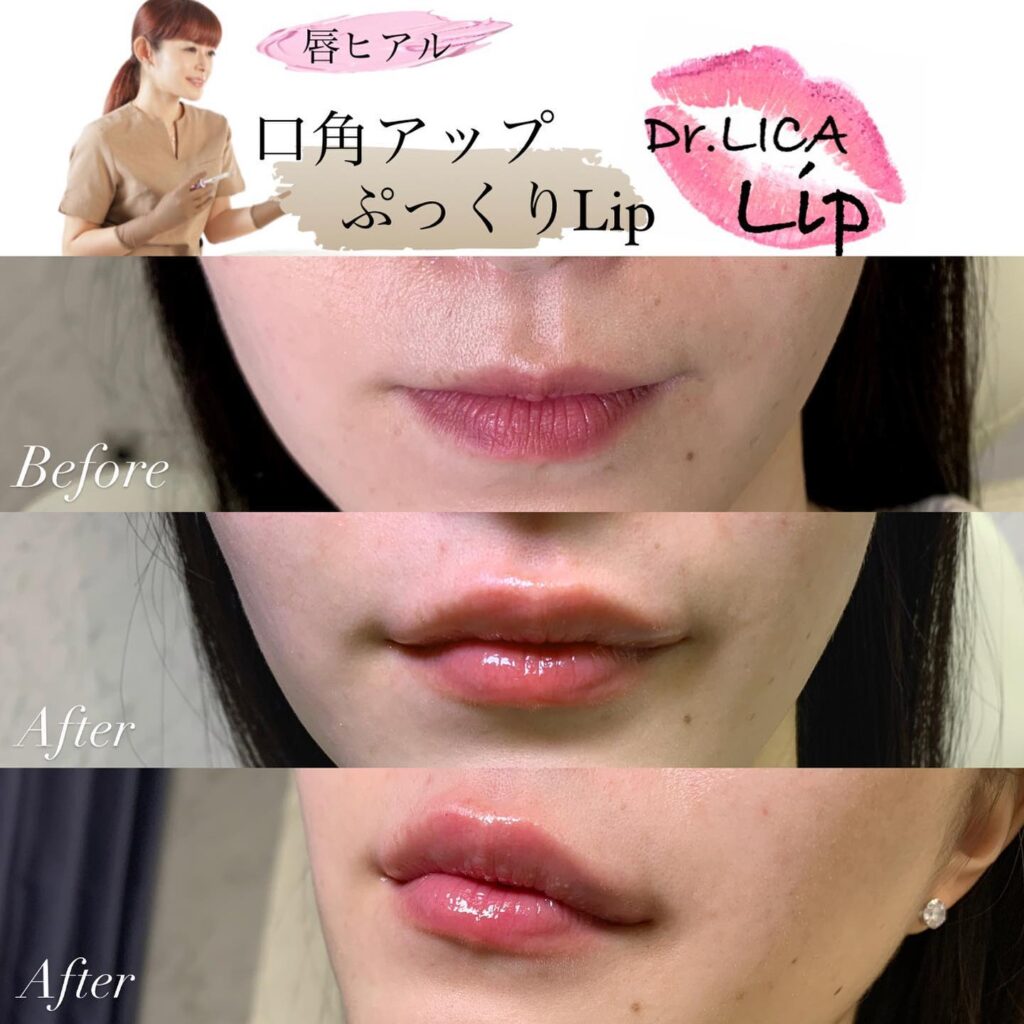 唇のヒアルロン酸で口角アップをした症例写真