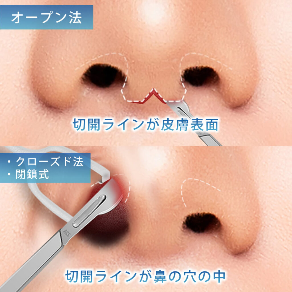 オープン法とクローズ法と閉鎖式の図解