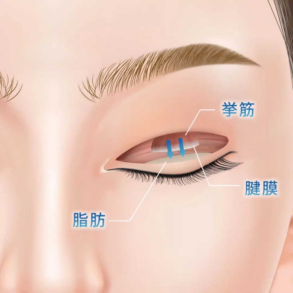 挙筋腱膜前転法で挙筋を引っ張っている図解