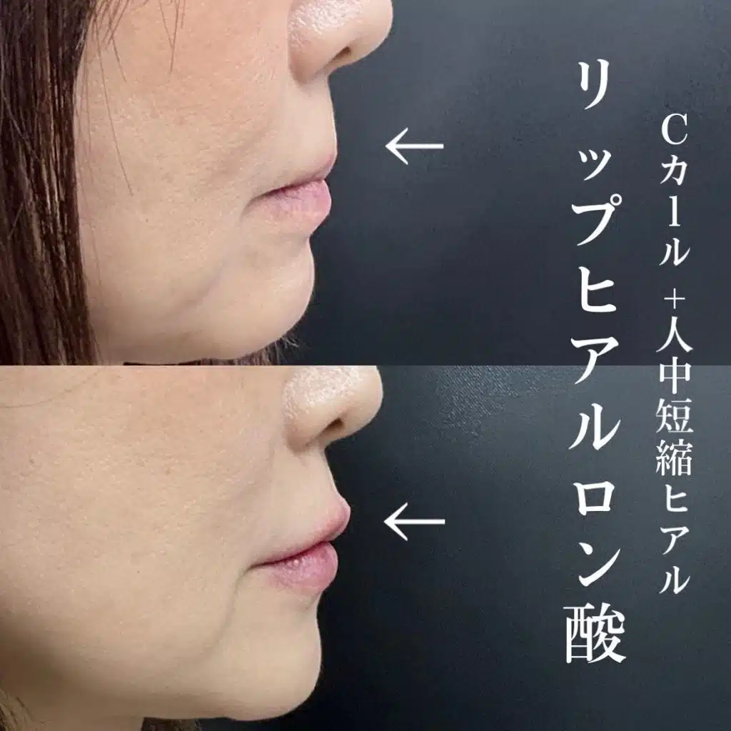 リップ ヒアルロン酸