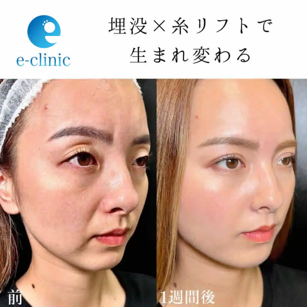 埋没 糸リフト