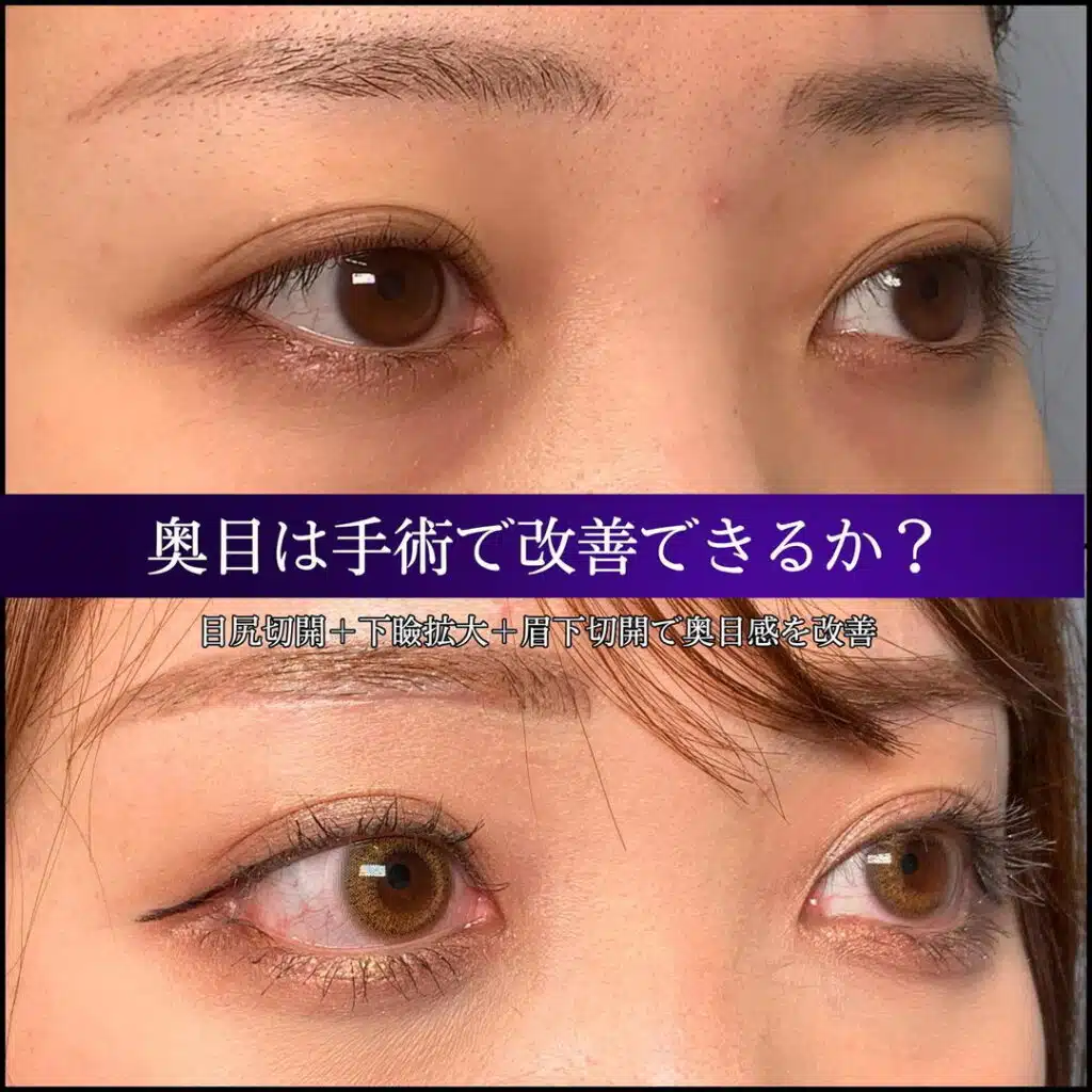 目尻切開　新宿