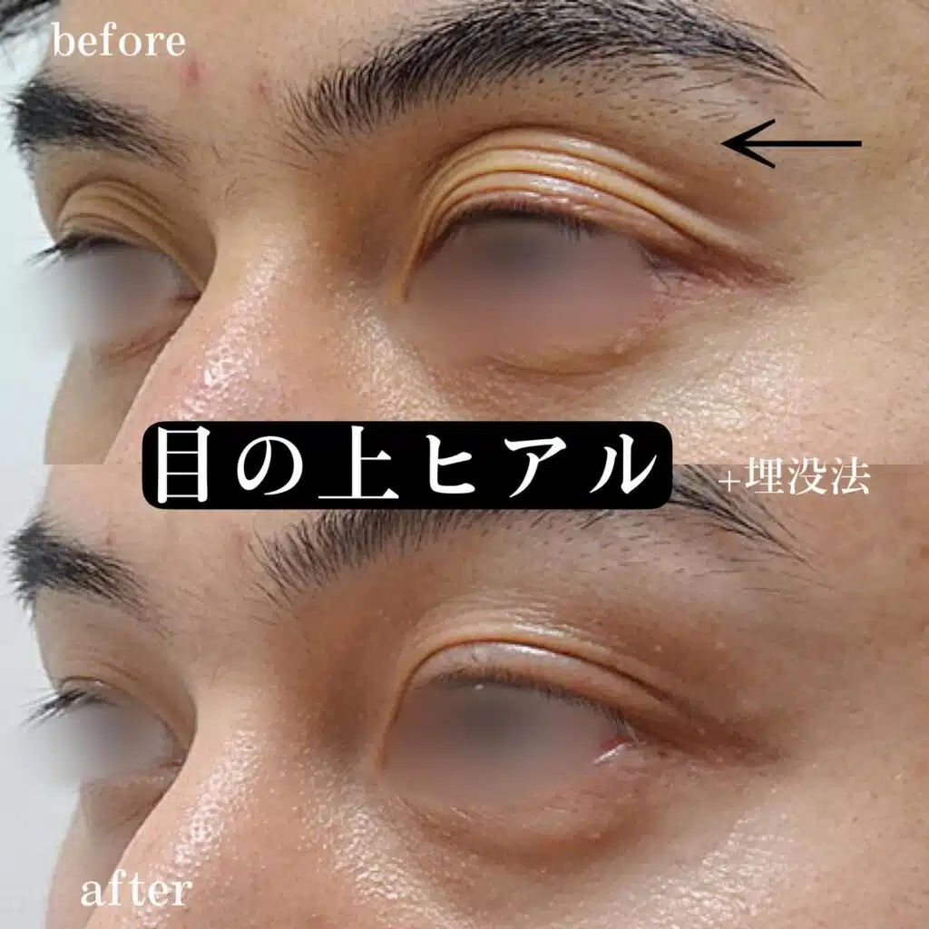 目の上 ヒアルロン酸