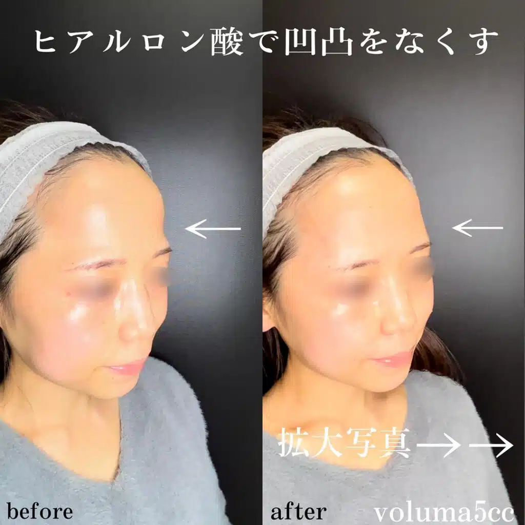 ヒアルロン酸