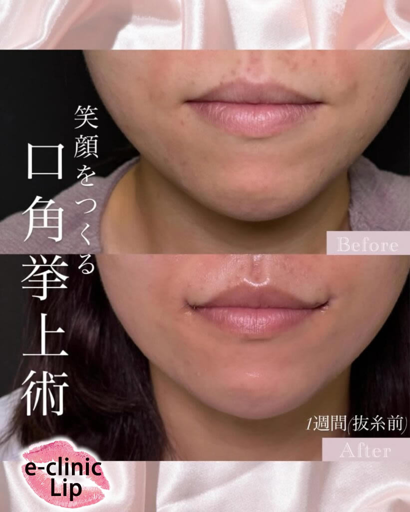 口角挙上の症例写真
