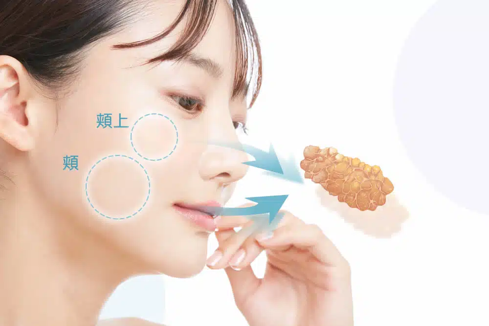 頬の脂肪吸引