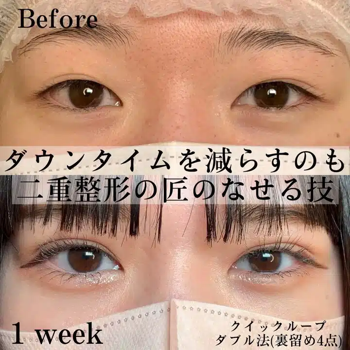 クイックループダブル法