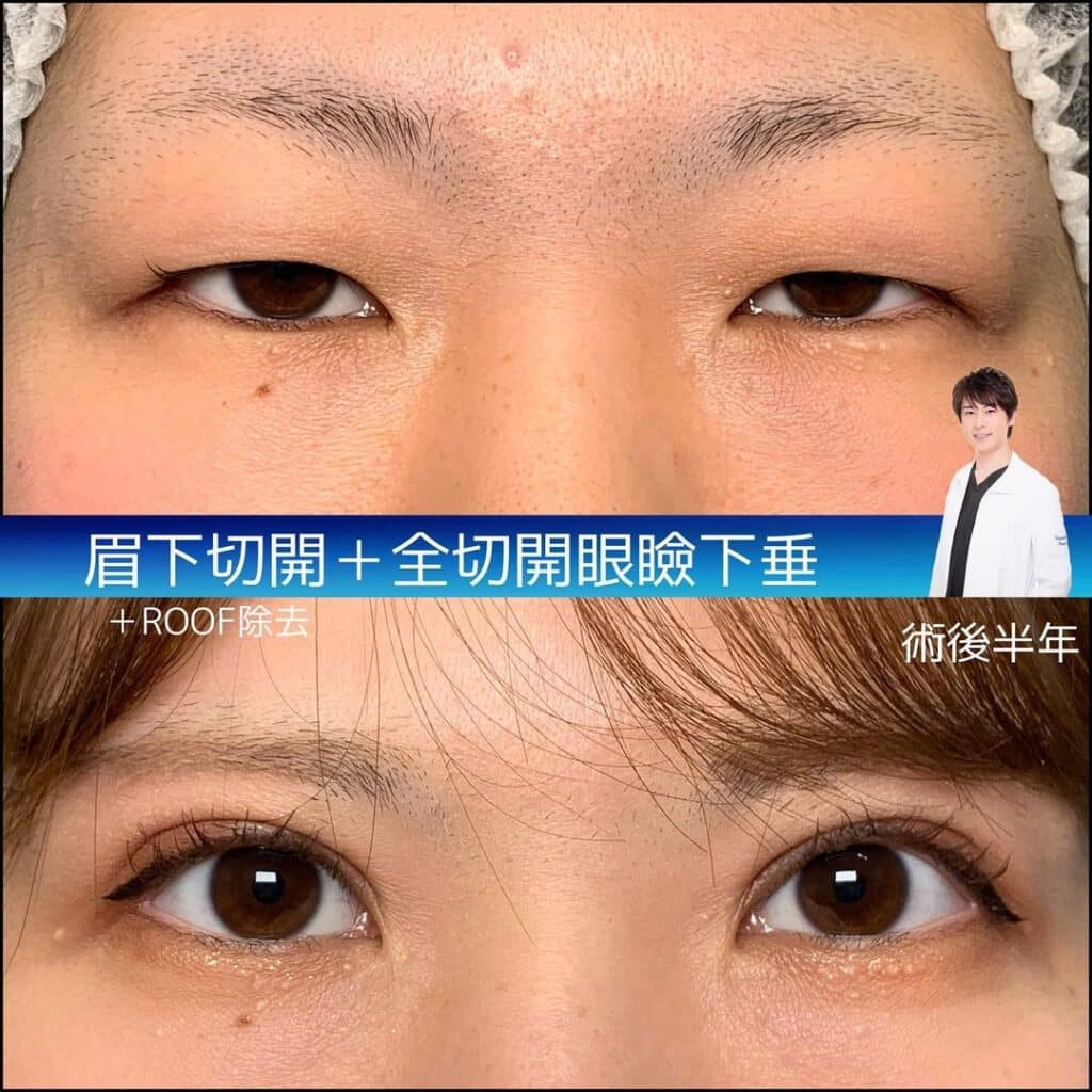 眉下切開と眼瞼下垂の手術を同時に行った症例写真