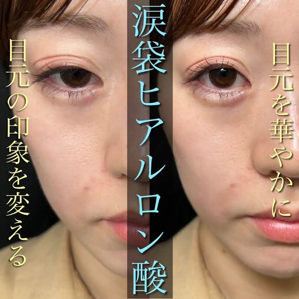 涙袋のヒアルロン酸注射　新宿