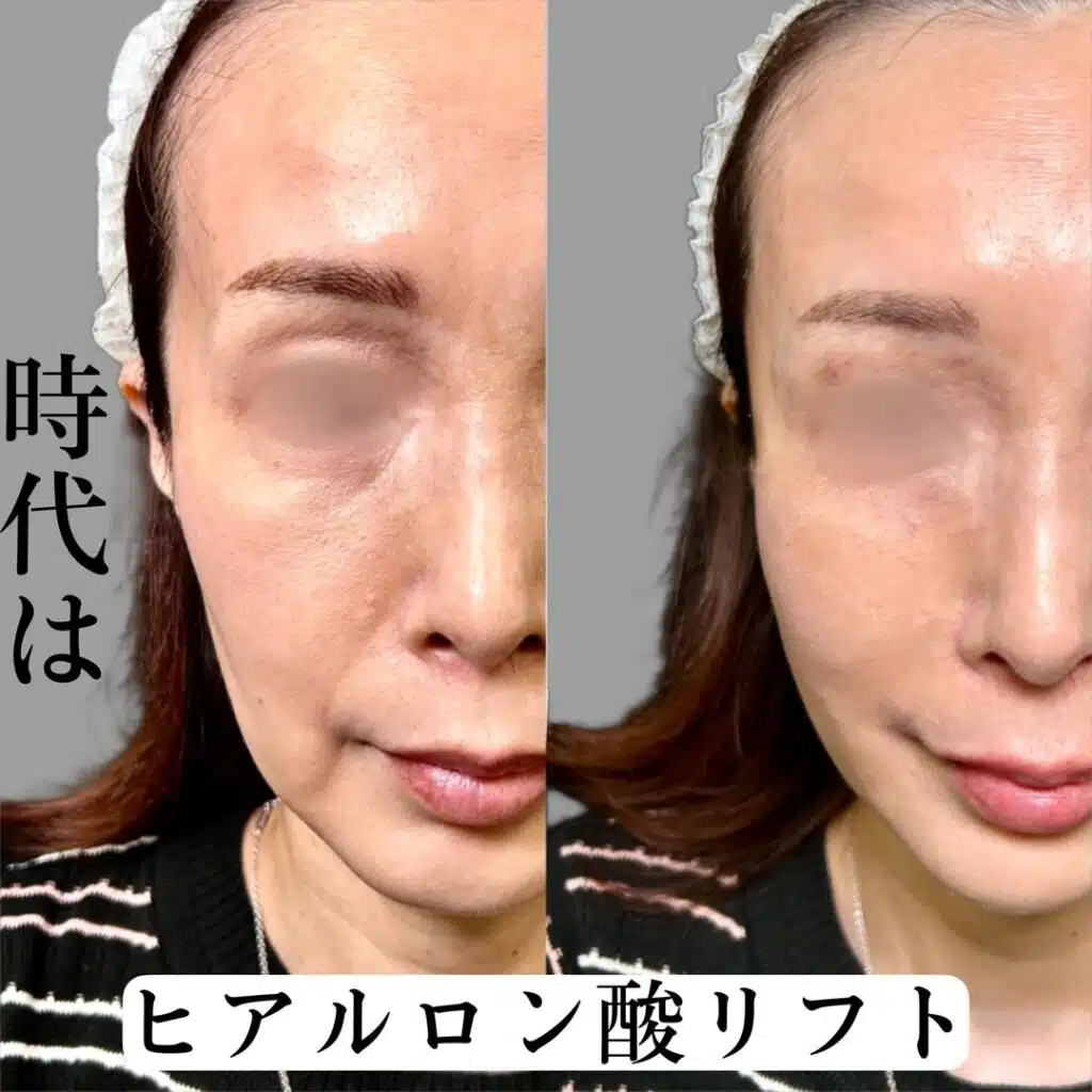 ヒアルロン酸リフト
