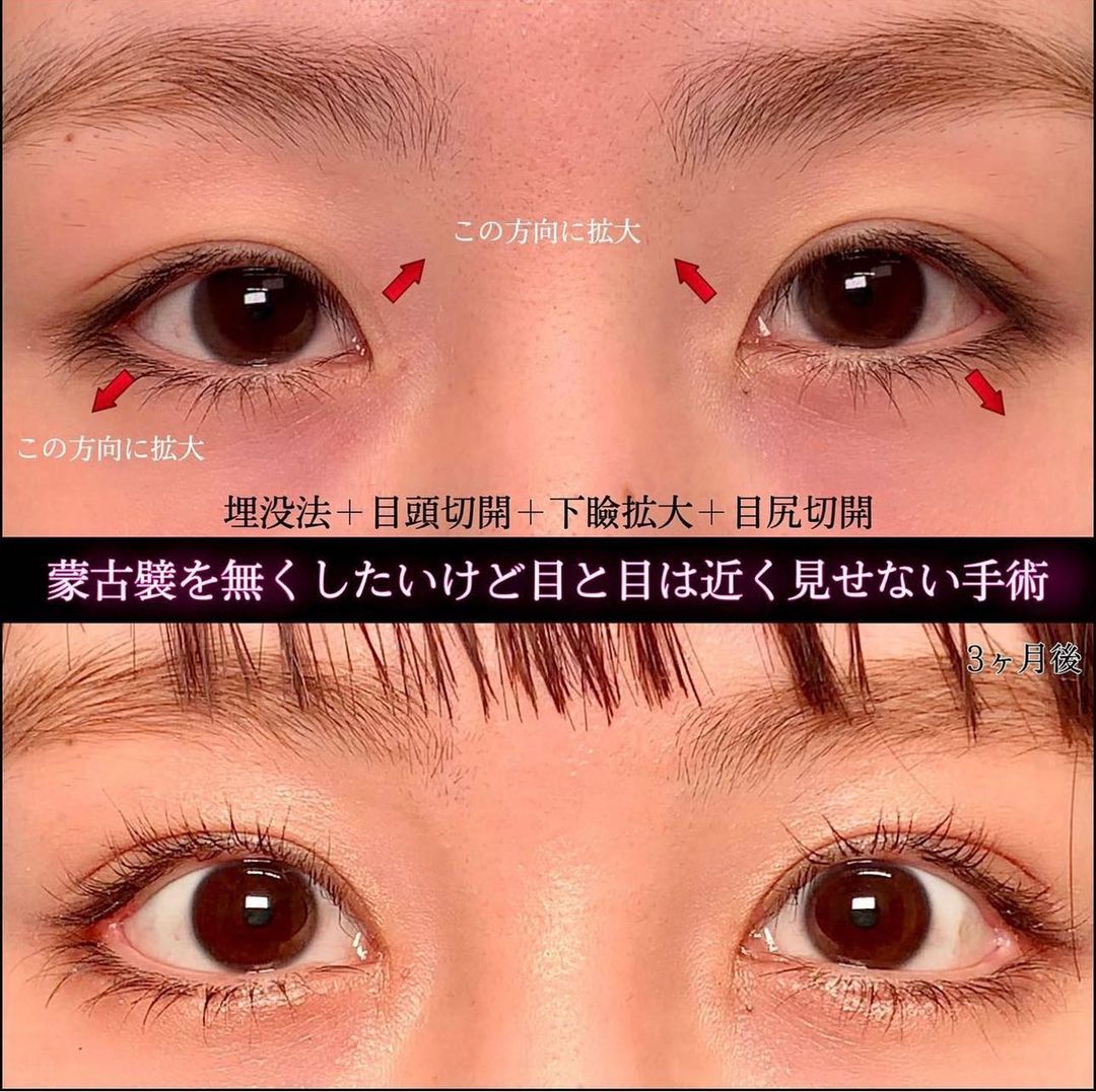 目頭切開とタレ目形成と目尻切開と埋没法の二重をした3ヶ月後の症例