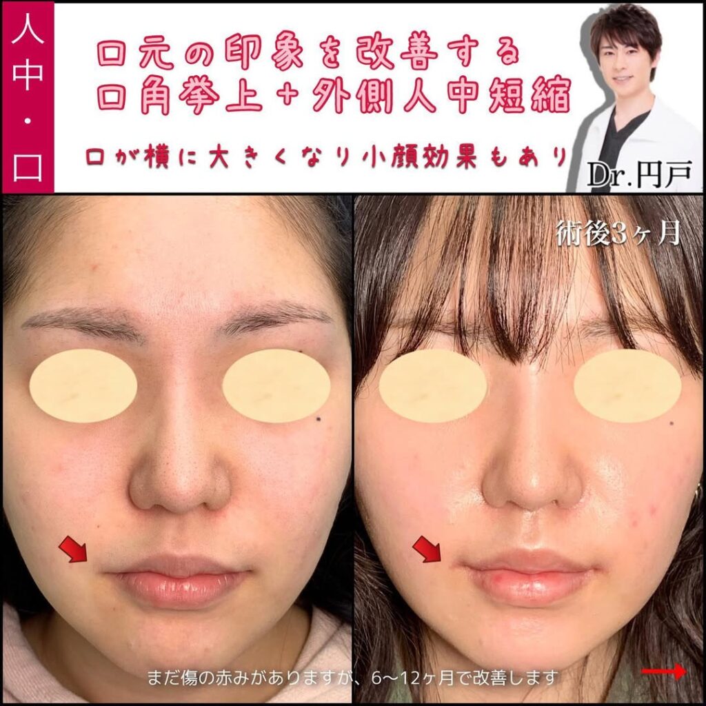 円戸医師の外側人中短縮の症例