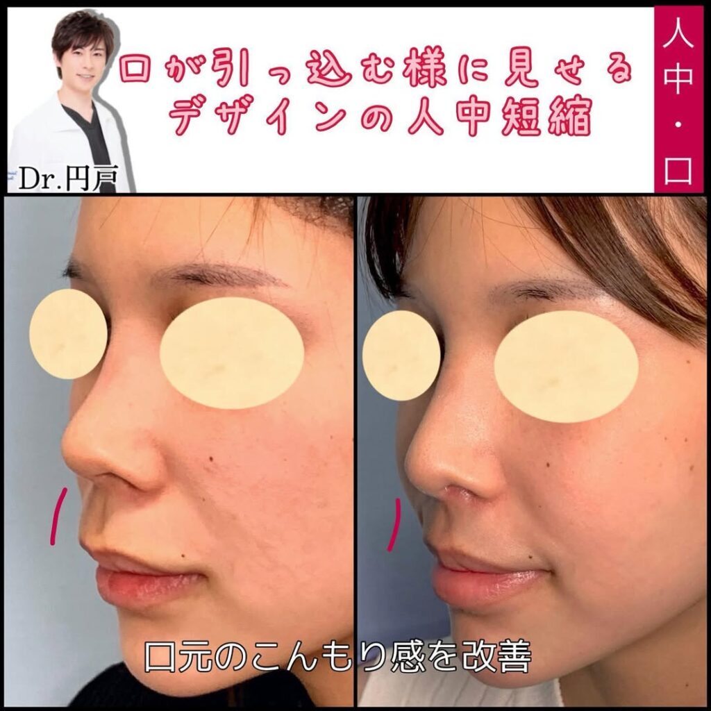 円戸医師の人中短縮術