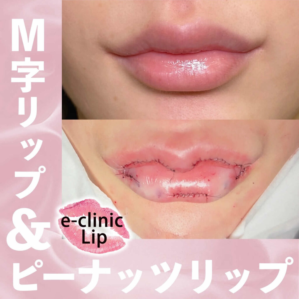 口元の美容整形 | eクリニック新宿院【公式】｜美容整形・美容外科