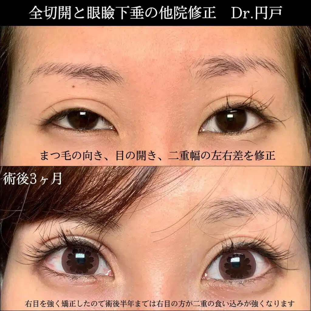 全切開　眼瞼下垂　新宿