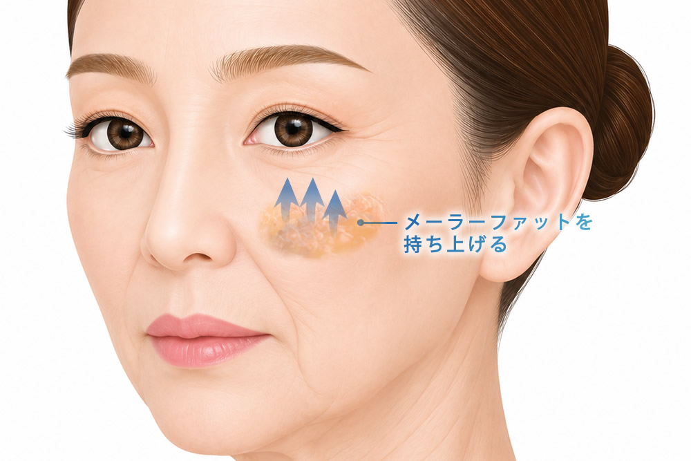 ディープミッドフェイスリフトの手術方法の図解