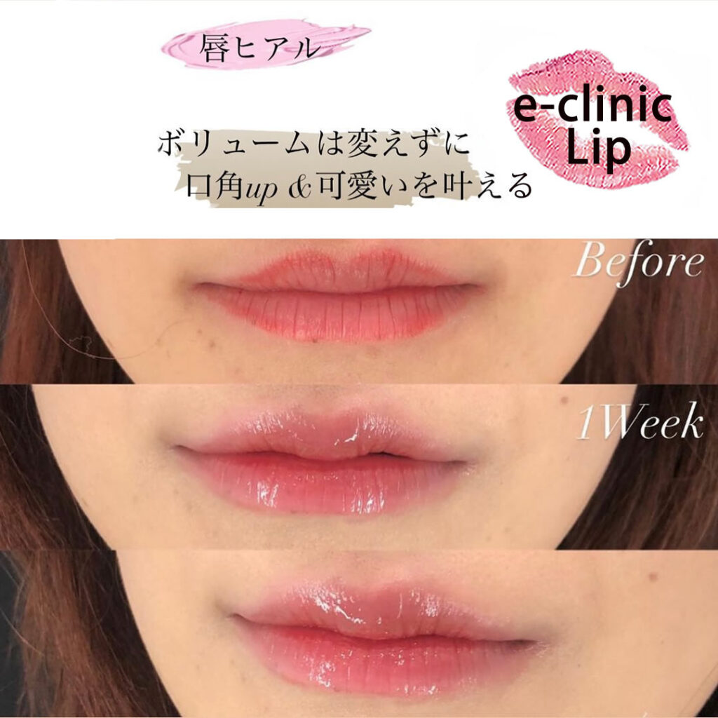唇のヒアルロン酸でCカールを作った症例写真