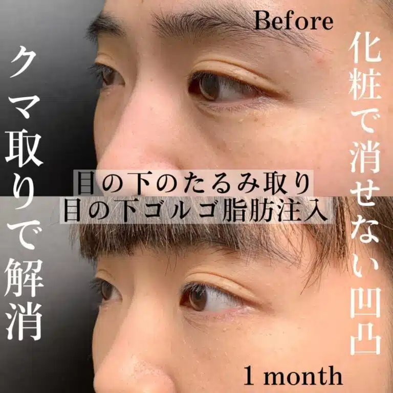たるみ取り 脂肪注入