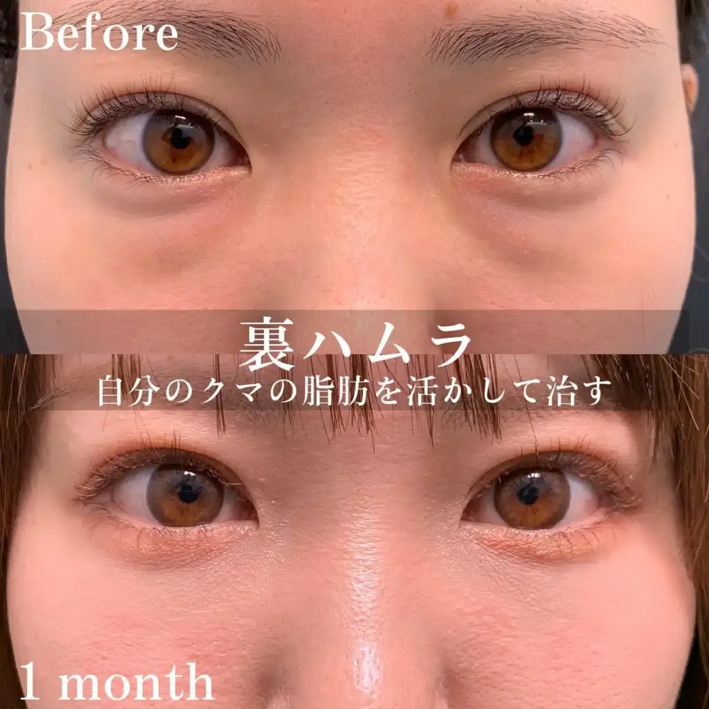 裏ハムラ