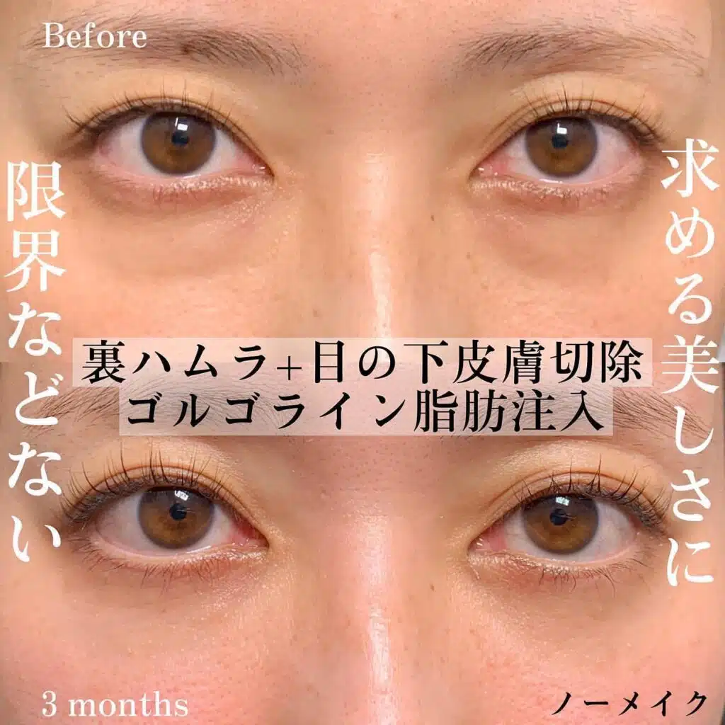 皮膚切除 脂肪注入