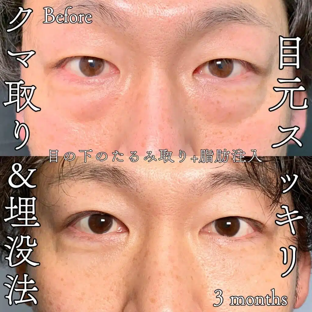 クマ取り