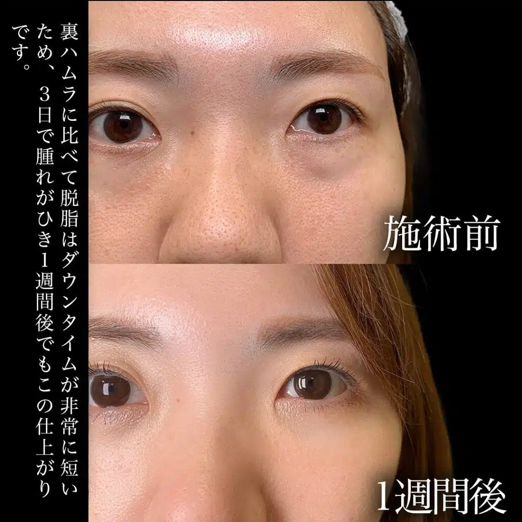 脱脂 ヒアルロン酸