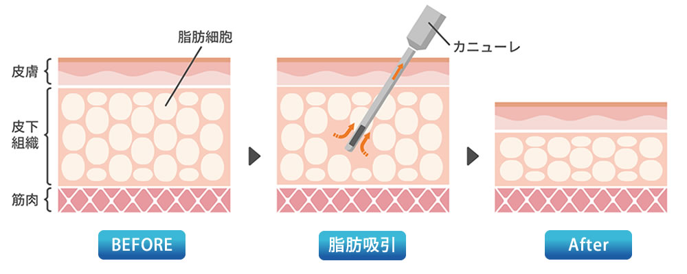 脂肪吸引の図解