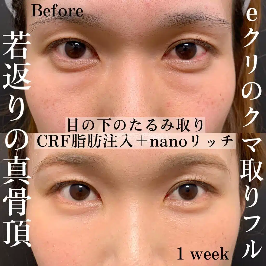 たるみ取り 脂肪注入 ナノリッチ