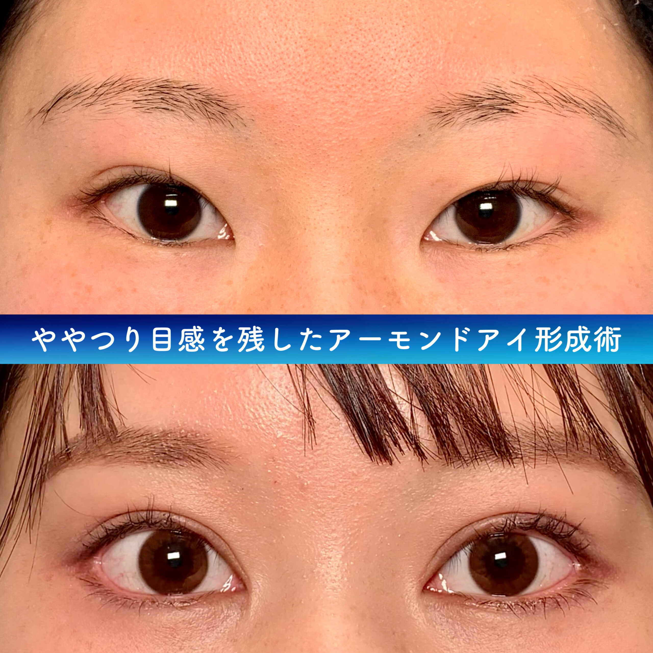 目尻靭帯移動術の傷跡を説明する症例