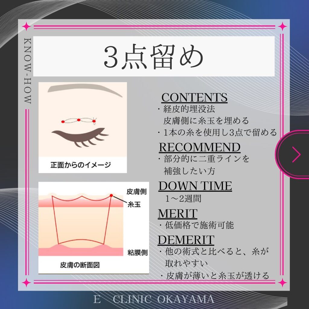 埋没法の3点留めの解説の図解