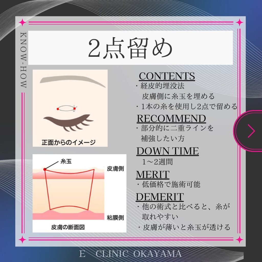 埋没法の2点留めの解説の図解