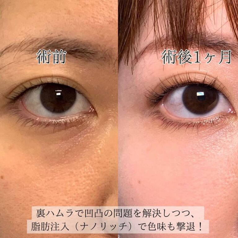 eクリニック新宿院の裏ハムラとナノリッチで脂肪注入をした1か月後の症例