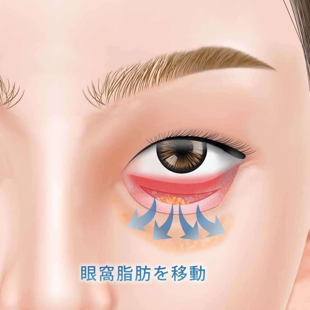 裏ハムラで眼窩脂肪を移動させている図解